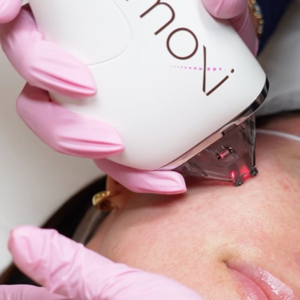 BBL+Moxi<span class="trademark" style="font-size:0.4em!important;top:-1.1em!important">™</span>